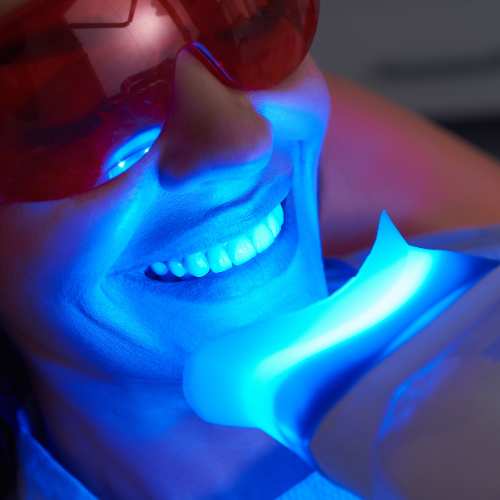 How Do People Like You Choose Between At-Home and In-Clinic Whitening Cheltenham?