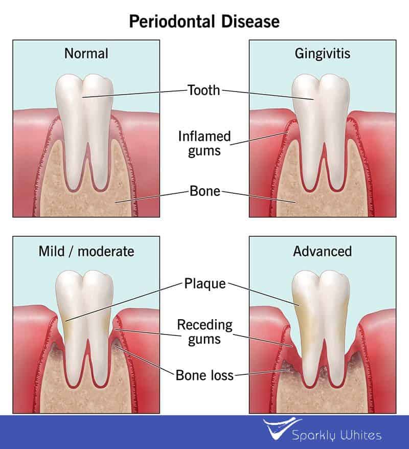Can Gum Bleeding Really Indicate Poor Oral Hygiene Cheltenham?